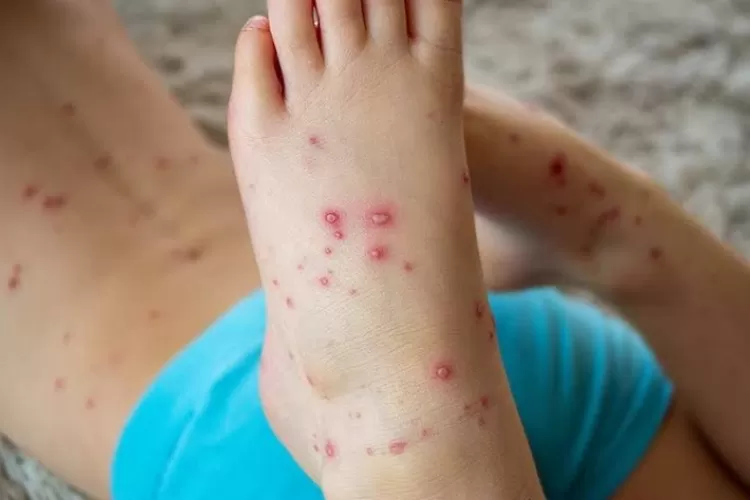 Campak Menular dengan Cepat, Ini Gejala yang Harus Diwaspadai