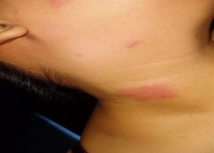 Langkah Mencegah Cacar Api: Pola Hayati Sehat dan Vaksinasi